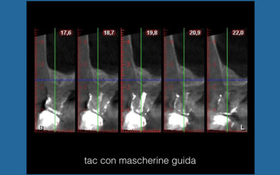 GRANDI RIALZI DI SENO MASCELLARE
